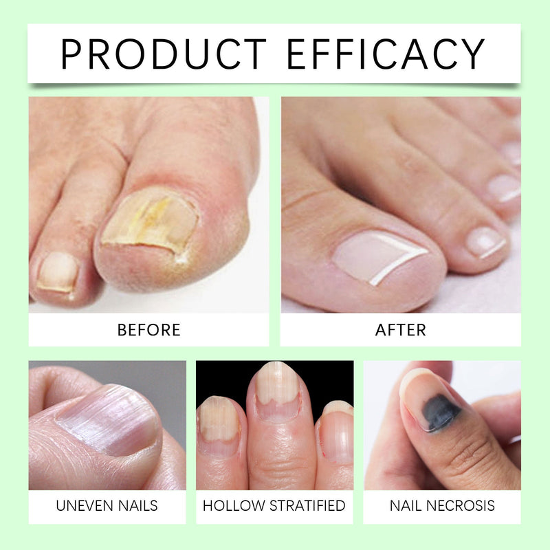 Onychomycosis Repair Essence Hand And Foot Nutrition My Store